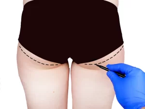 جراحی پروتز باسن