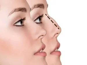 درباره جراحی زیبایی بینی