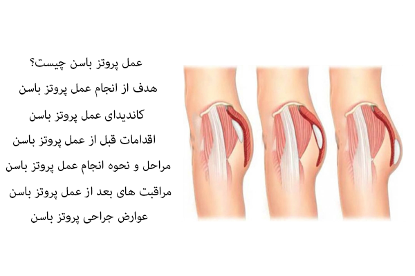 عمل پروتز باسن چیست؟