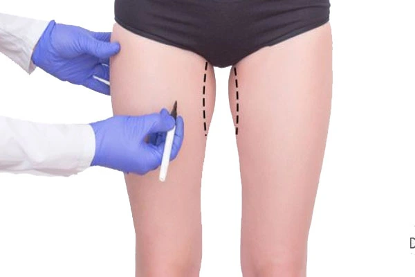 جراحی لیفت ران