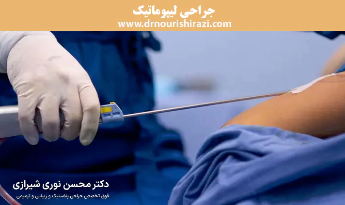 جراحی لیپوماتیک