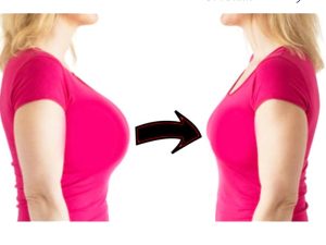 جراحی ماموپلاستی