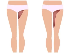 درباره جراحی لیفت ران