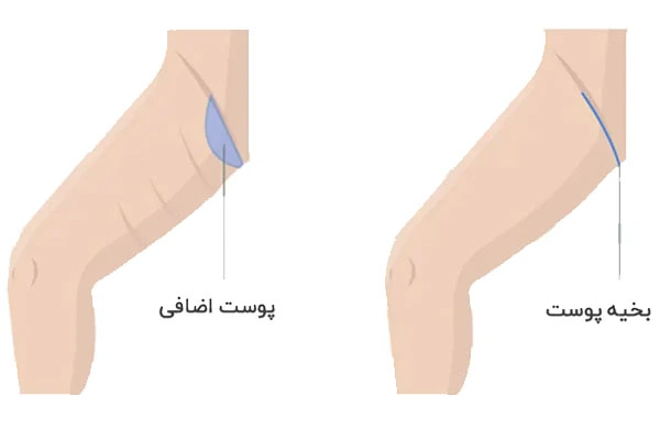 نحوه انجام جراحی لیفت ران