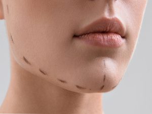 درباره جراحی پروتز چانه