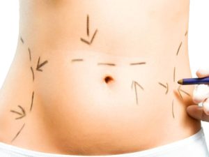 درباره لیپوساکشن