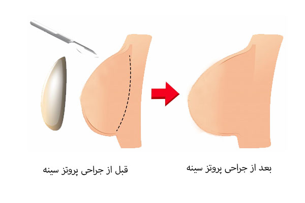 قبل و بعد از جراحی پروتز سینه