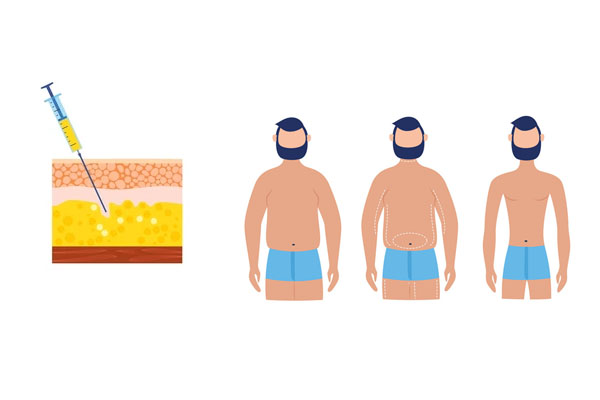 لیپوسااکشن