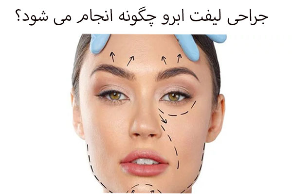نحوه انجام جراحی لیفت ابرو