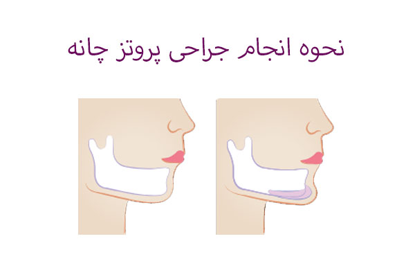 نحوه انجام جراحی پروتز چانه