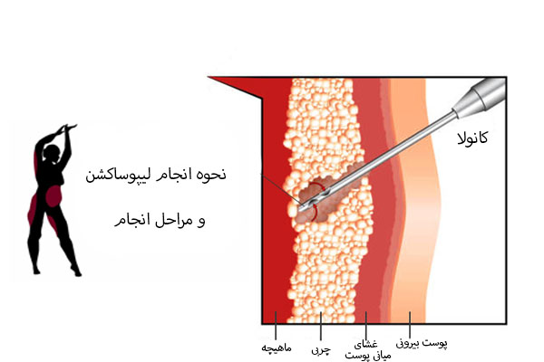 نحوه انجام لیپوساکشن و مراحل