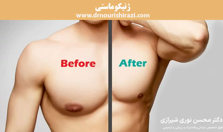 ژنیکوماستی