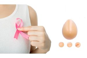 جراحی پروتز سینه بعد از سرطان