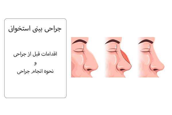 جراحی بینی استخوانی
