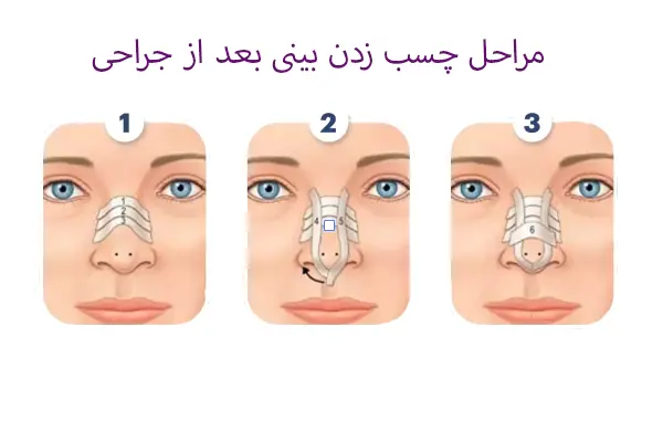 مراحل چسب زدن بینی بعد از جراحی