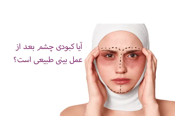کبودی چشم بعد از عمل بینی