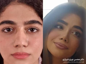 مزایای جراحی بینی گوشتی