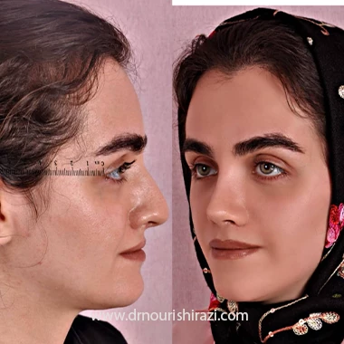 جراحی بینی طبیعی برای چه کسانی مناسب است؟