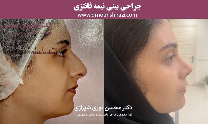 جراحی بینی نیمه فانتزی