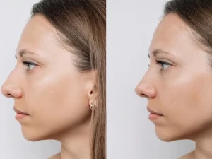 جراحی بینی ترمیمی در گرگان