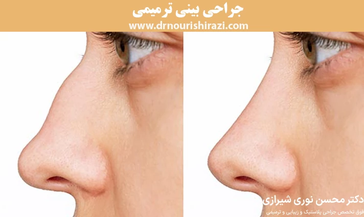 جراحی بینی ترمیمی
