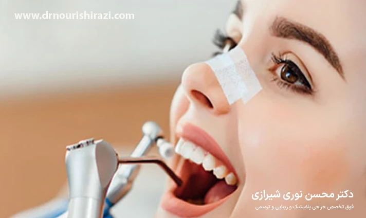 نکات مهم در انجام خدمات دندانپزشکی بعد از جراحی بینی