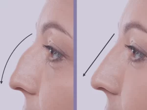 جراحی بینی عقابی در گرگان