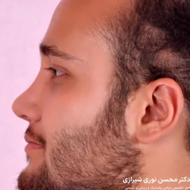 جراحی بینی نیمه فانتزی مردانه