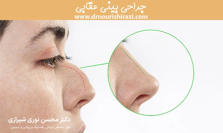 مزایای جراحی بینی عقابی