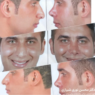نمونه کار جراحی بینی نیمه فانتزی مردانه