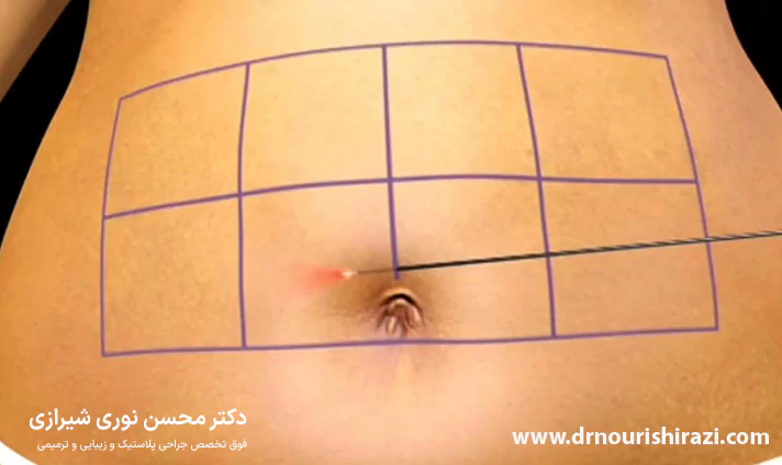 مزایای عمل لیپوماتیک