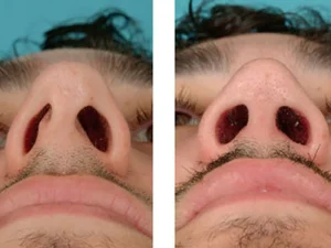 جراحی انحراف بینی در گرگان