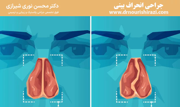 جراحی انحراف بینی